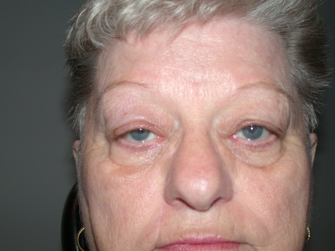 eyelid ptosis ringer